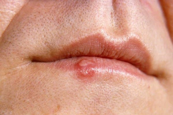 Whats a fever blister
