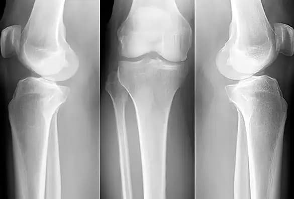 X-ray showing bones due to osteoporosis symptoms