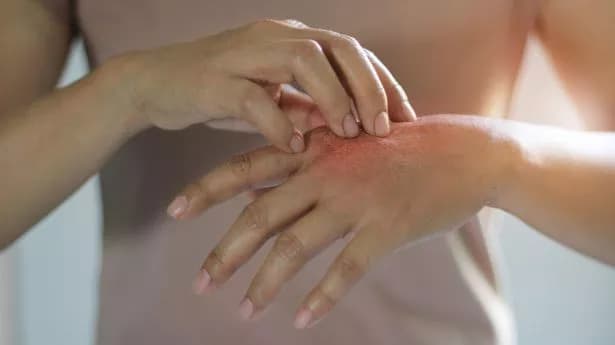 lymphoma symptoms on the hand