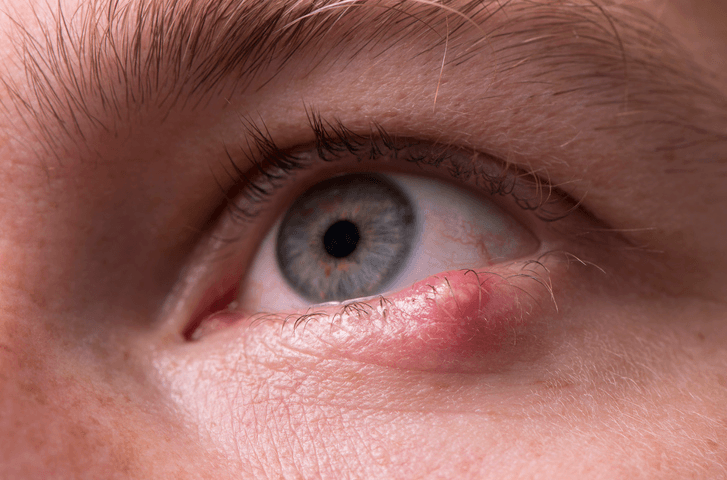 Eye Stye condition