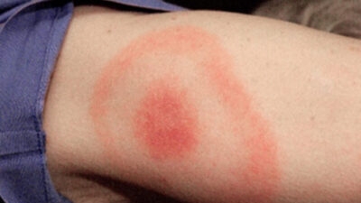 A woman's arm exhibiting a potential symptom of Lyme Disease with a red spot on it.