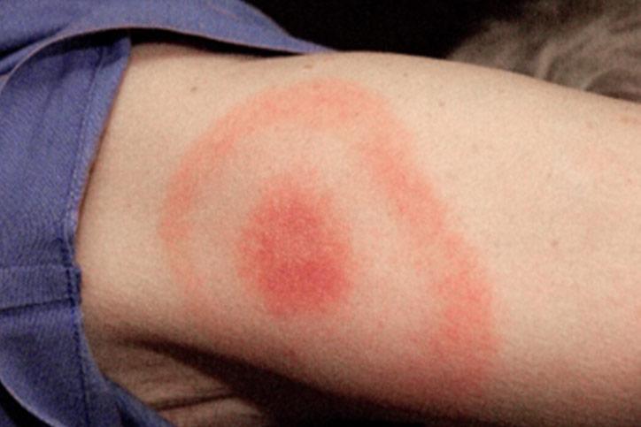 A woman's arm exhibiting a potential symptom of Lyme Disease with a red spot on it.