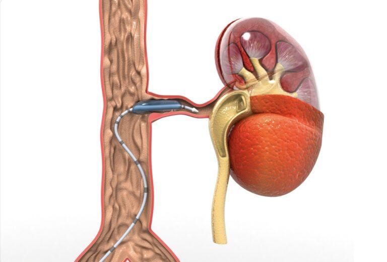 Peripheral Arterial disease