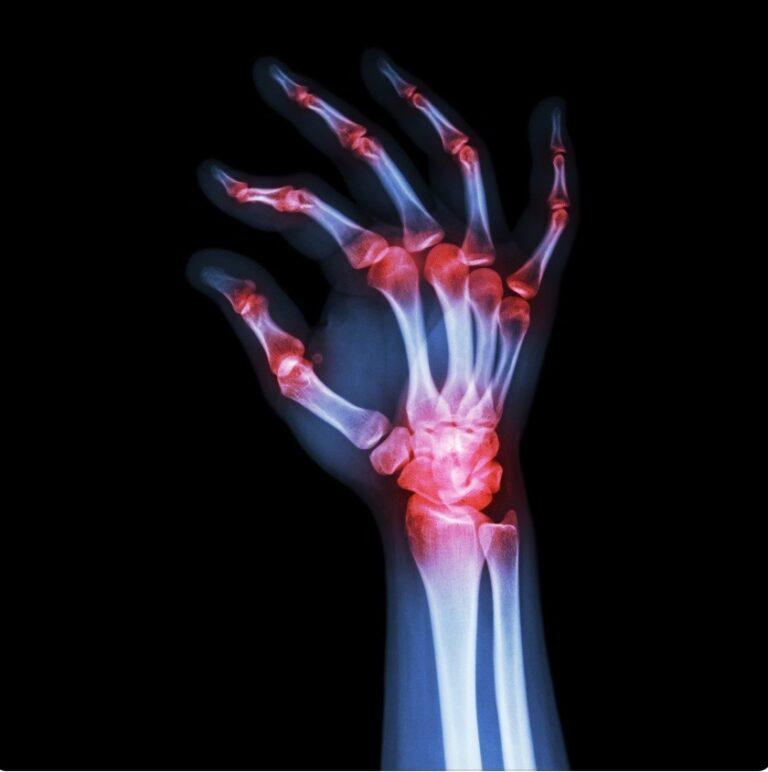 Rheumatoid arthritis