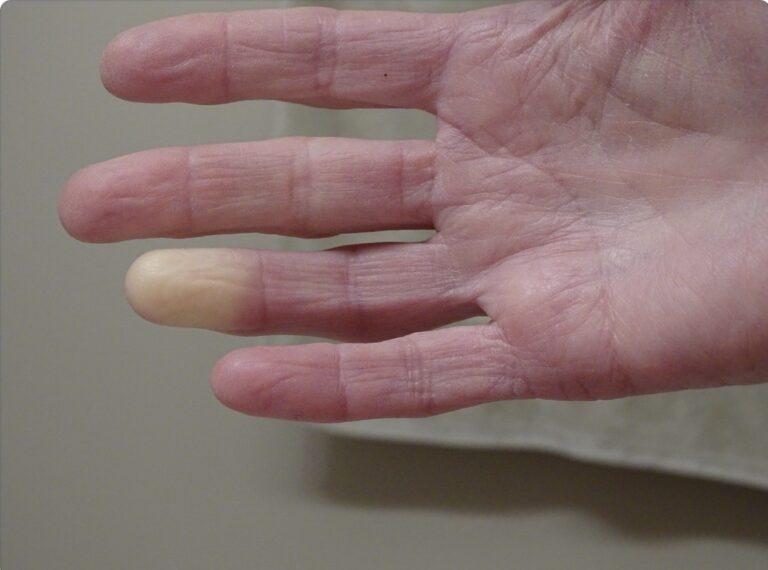 Raynauds
