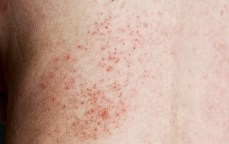 skin rash