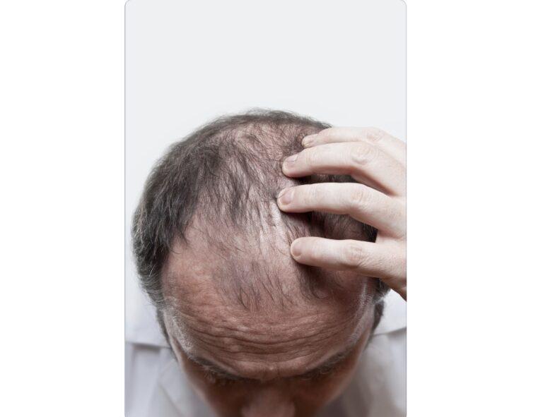 Mens baldness pattern