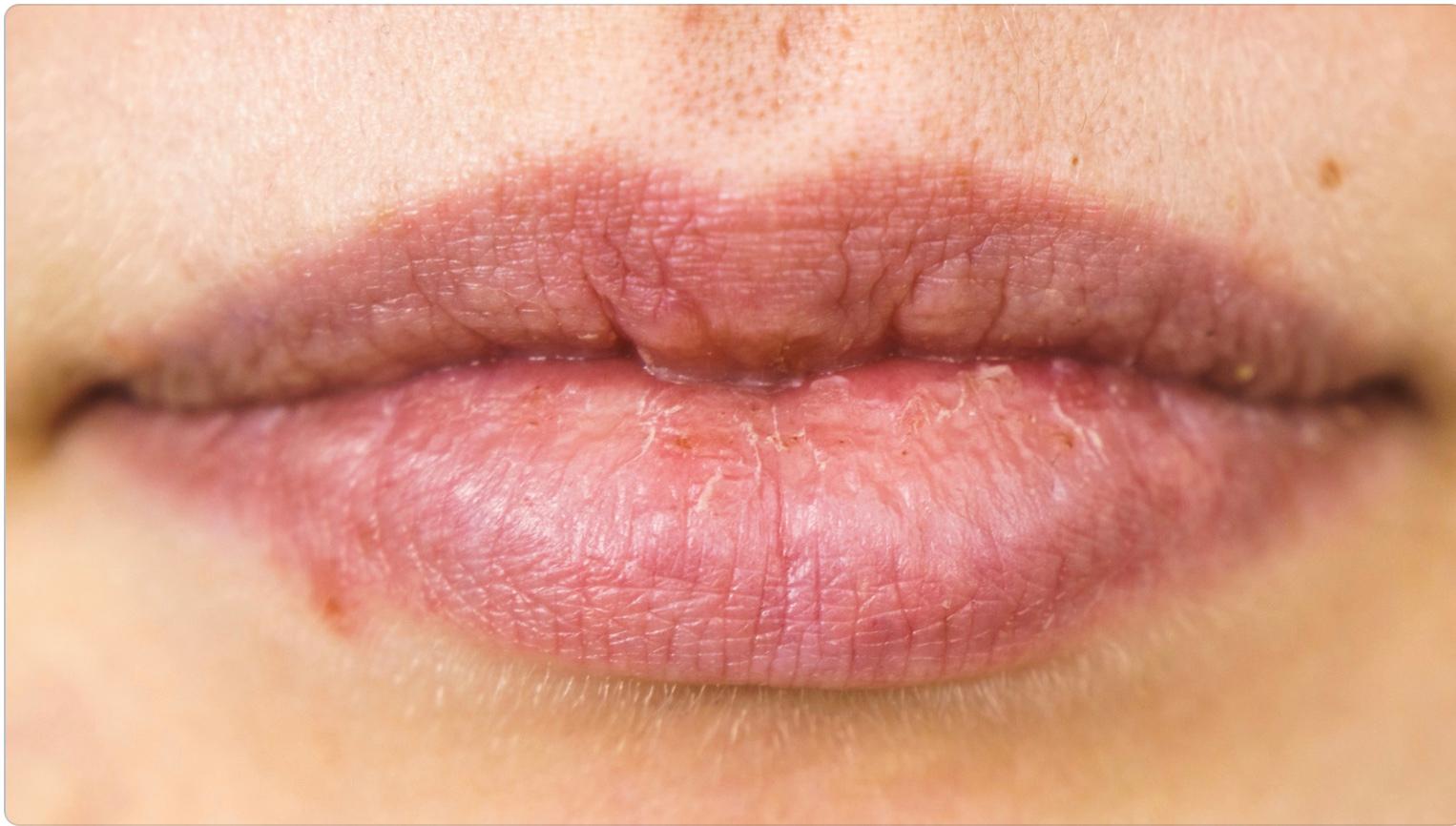 Cold Sore