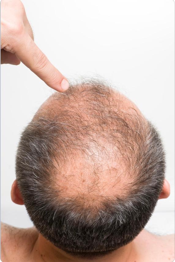 male baldness