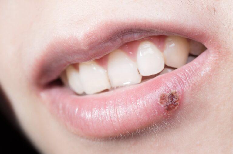 Cold sore in lips