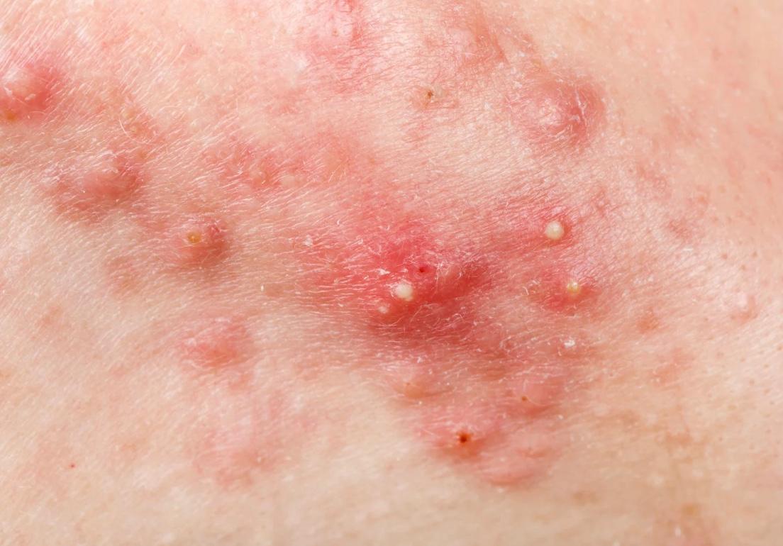 Cystic Acne