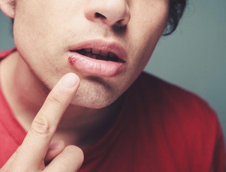 Cold sore