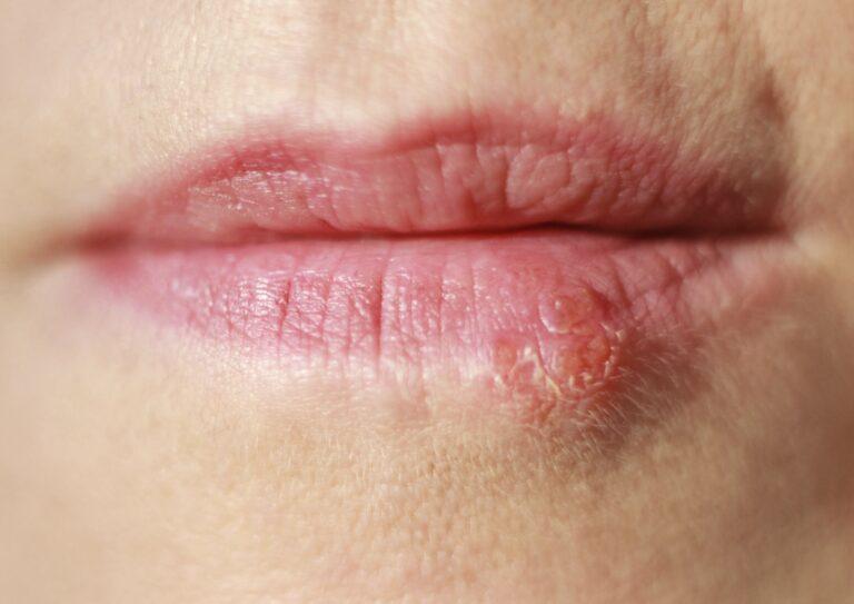 Lip cold sore