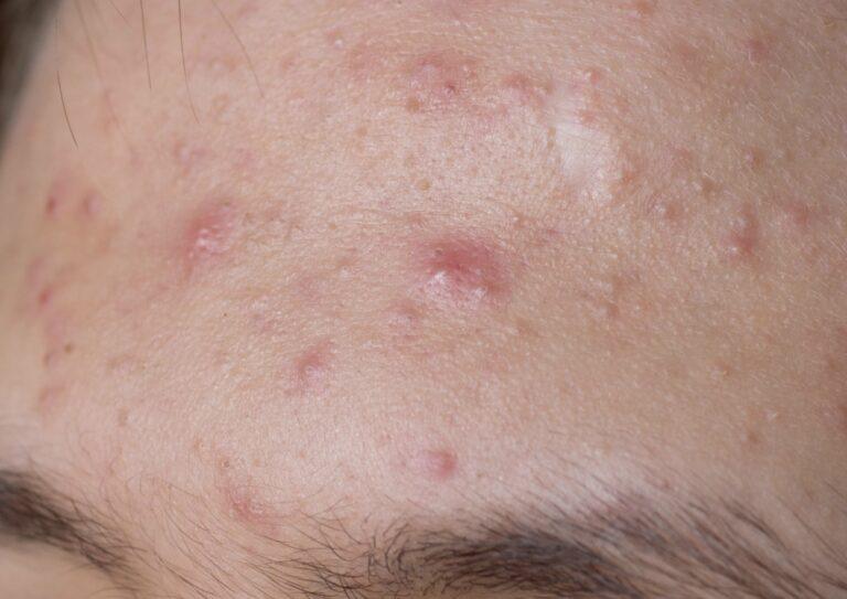 Acne on forehead