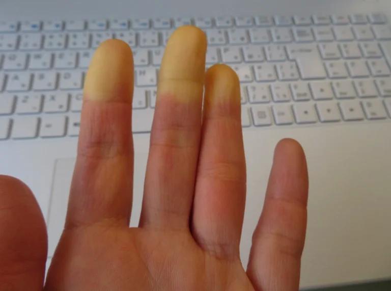 A person's hand with two fingers demonstrating keyboard use, potentially affected by Raynaud's disease.