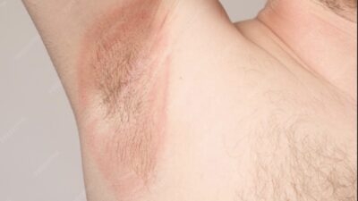 A man with a rash on his armpit.