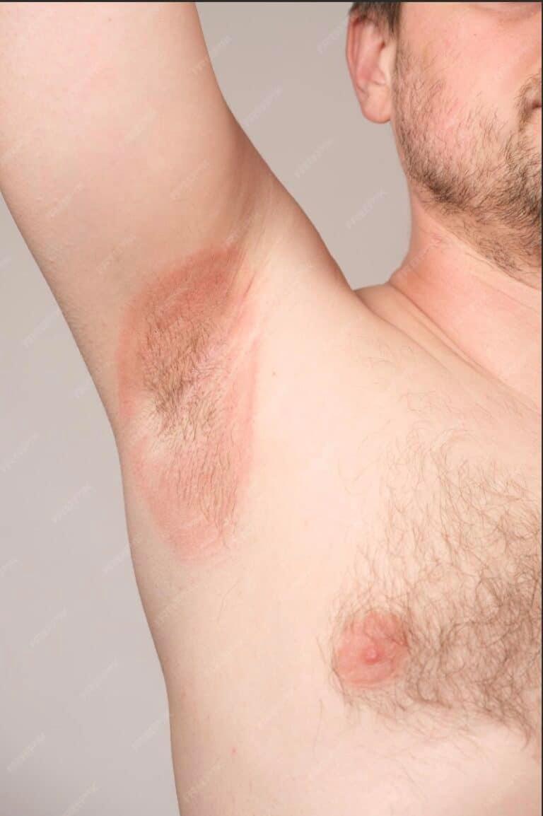 A man with a rash on his armpit.