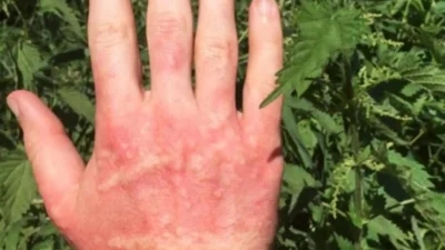 A person's hand with a red rash caused by nettle stings, requiring NHS treatment.
