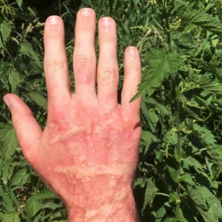A person's hand with a red rash caused by nettle stings, requiring NHS treatment.