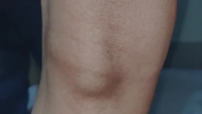 A close up of a person's knee showing signs of a Baker cyst.