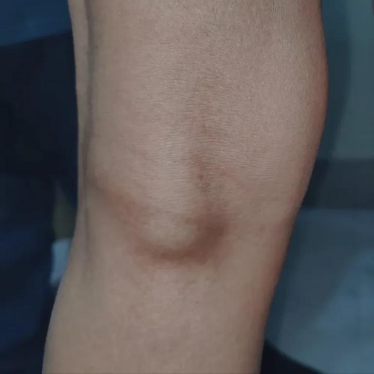A close up of a person's knee showing signs of a Baker cyst.