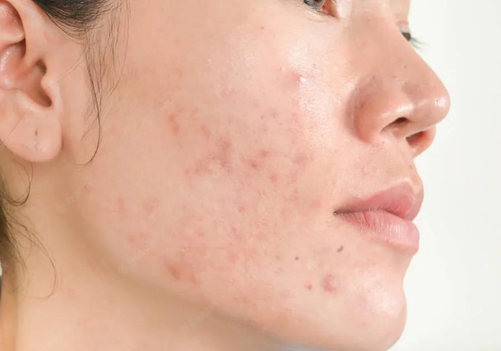 A woman with cysts on her face.