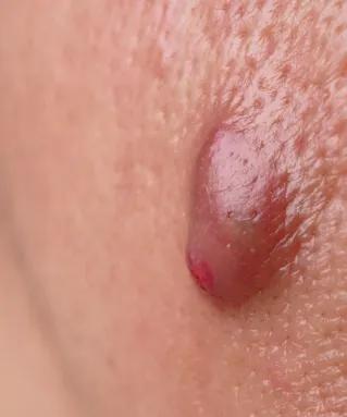 Close up of a red spot on a person's skin, possibly caused by a cyst.