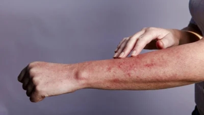 A woman with a red rash on her arm, trying to identify if it could be associated with HIV.