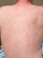 A man with a rash on his back that looks like measles.