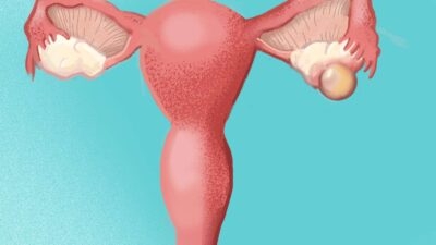An illustration of a woman's uterus, highlighting the potential dangers of ovarian cysts.