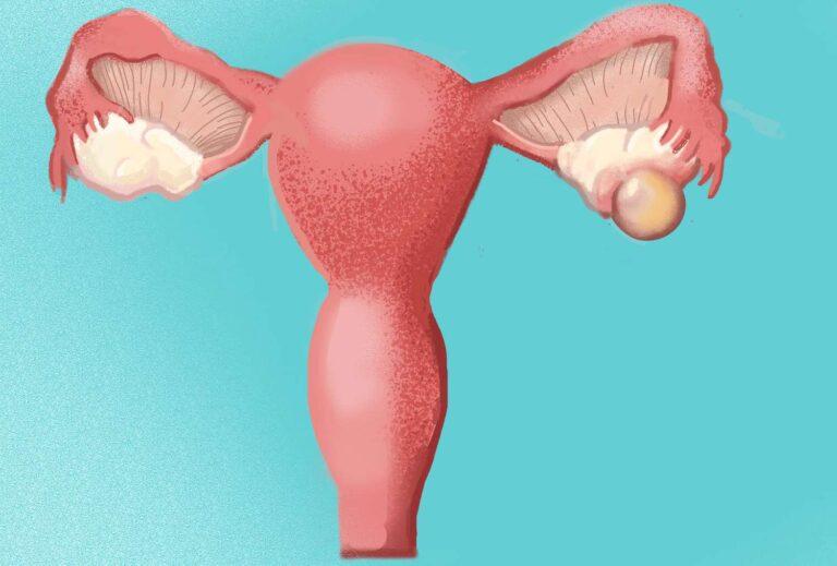 An illustration of a woman's uterus, highlighting the potential dangers of ovarian cysts.