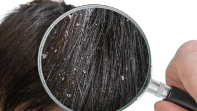 A man examining his hair for dandruff causes using a magnifying glass.