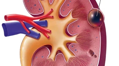A diagram of a kidney with a blood vessel in the renal system.