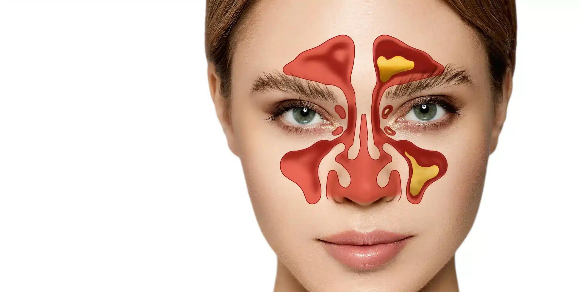 A woman's face with red nose caused by sinus issues.