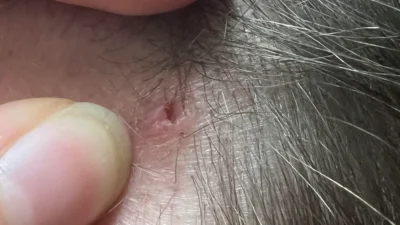 A close up of a person's head with an ingrown hair.