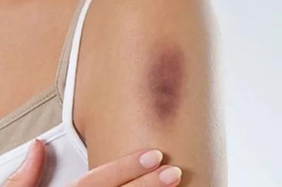 Close-up of a hematoma on an upper arm with a person's hand gently touching the area.