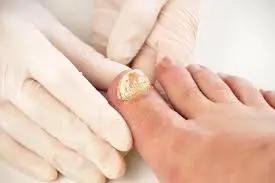 A person wearing white gloves examines a toenail prone to fungal infections.