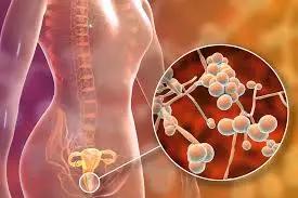 Illustration of a female body with a magnified view of fungal cells in the vaginal area, indicating a vaginal yeast infection, which can be caused by factors such as birth control.