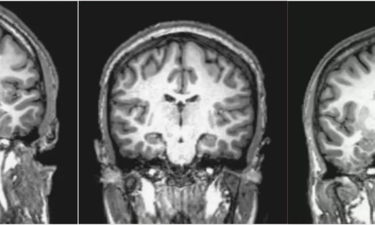 MRI scan of a brain, illustrating structural abnormalities often associated with schizophrenia, a mental health disorder that affects perception of reality