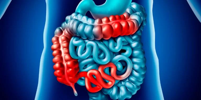 Detailed image of the digestive tract highlighting inflammation, representing the effects and symptoms of Crohn's disease.