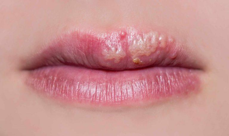 cold sore on lips