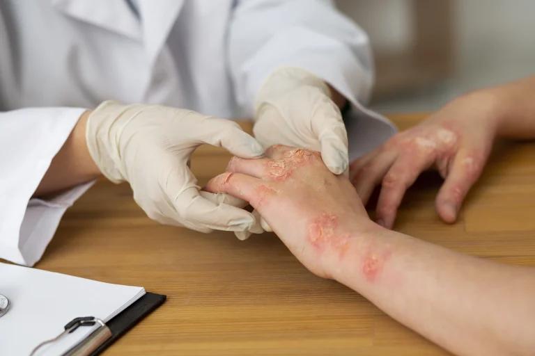 What is Eczema?