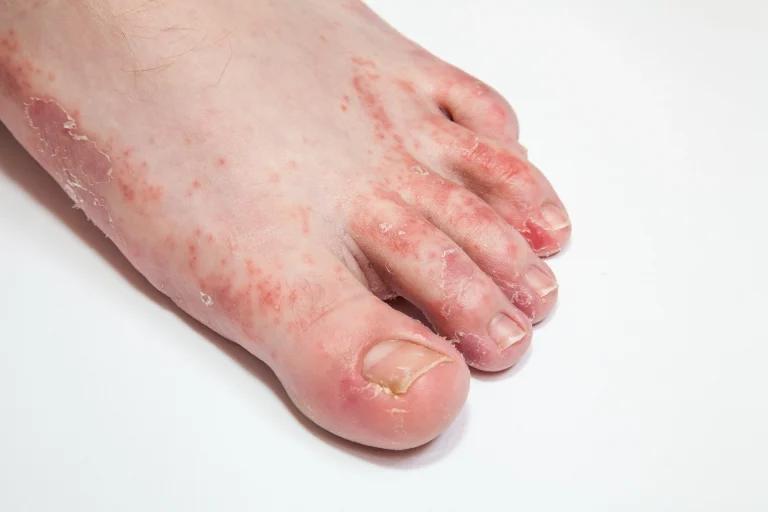 What is a fungal infection?