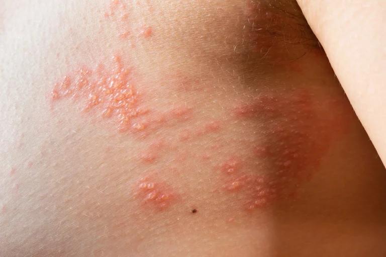 What is Shingles?