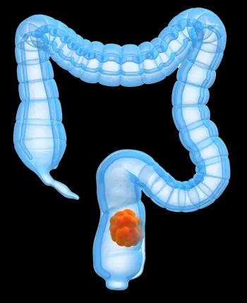 an image of the bowels and checking the signs of colorectal cancer