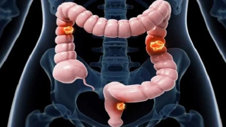 Illustration showing stage 3 colorectal cancer, with multiple tumors spreading to nearby lymph nodes in the colon