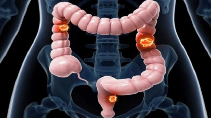 Illustration showing stage 3 colorectal cancer, with multiple tumors spreading to nearby lymph nodes in the colon