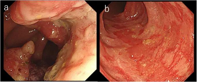 Endoscopic images showing stage 2 colorectal cancer. Image (a) displays a visible tumor obstructing the lumen with irregular, raised, and ulcerated mucosa. Image (b) shows an area of inflamed and thickened mucosa with erythematous patches and some irregularities, indicating the extent of local tumor invasion.
