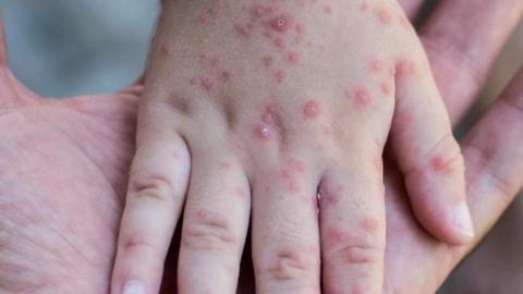 Taking a look at monkeypox symptoms
