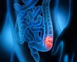 Where does colorectal cancer spread to first